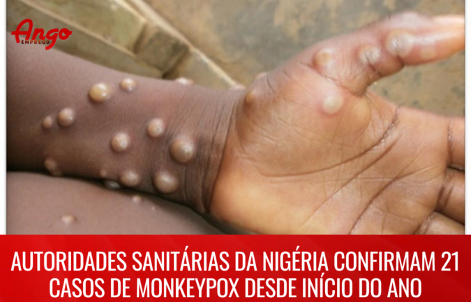 Nigéria confirmam 21 casos de Monkeypox desde início do ano